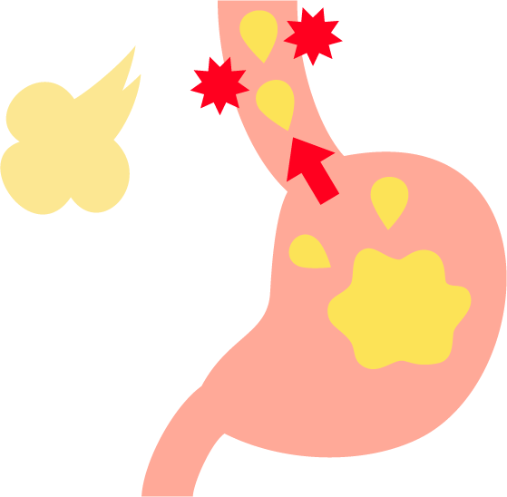 逆流性食道炎とは
